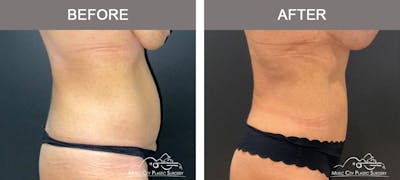 Liposuction Before & After Gallery - Patient 213095 - Image 3