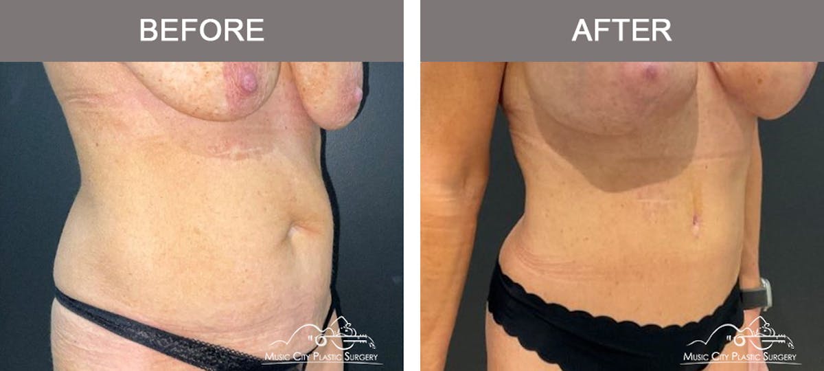 Abdominoplasty Before & After Gallery - Patient 312980 - Image 2