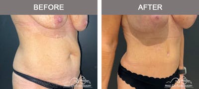 Liposuction Before & After Gallery - Patient 213095 - Image 2