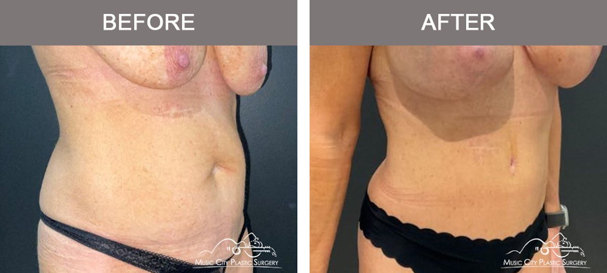 Liposuction Before & After Gallery - Patient 213095 - Image 2