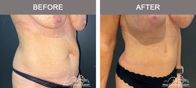 Abdominoplasty Before & After Gallery - Patient 312980 - Image 2
