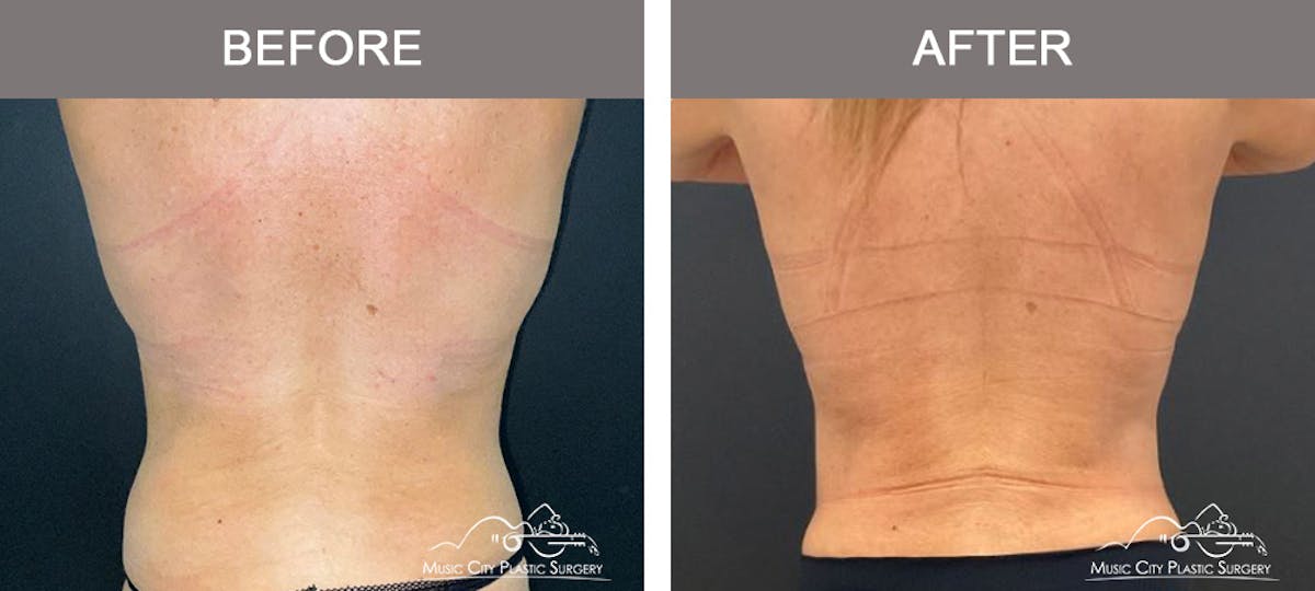Liposuction Before & After Gallery - Patient 213095 - Image 6