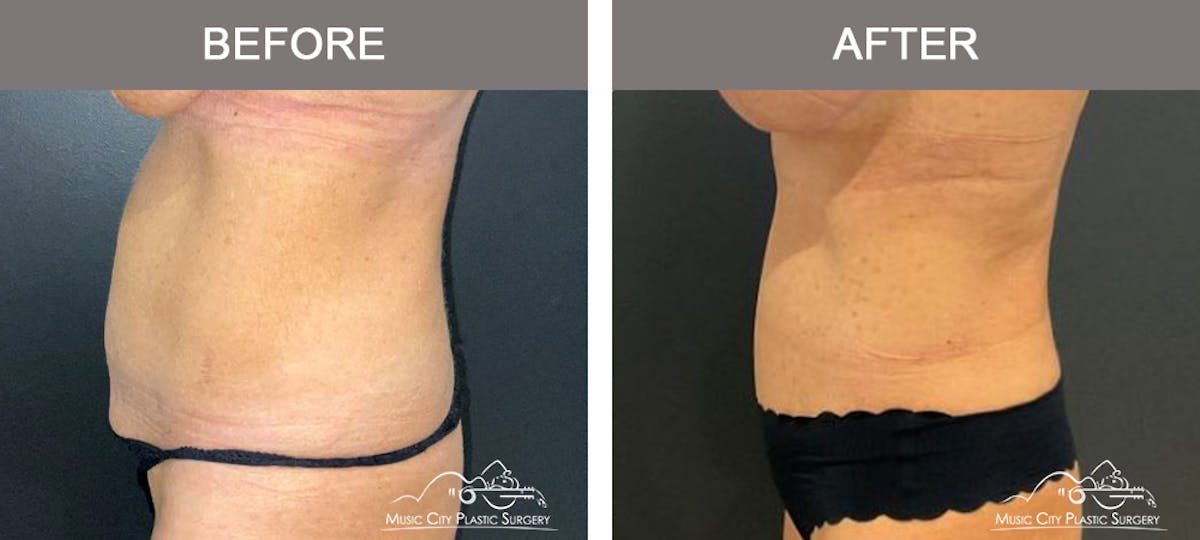 Liposuction Before & After Gallery - Patient 213095 - Image 5