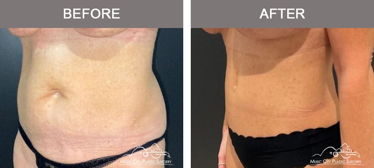 Abdominoplasty Before & After Gallery - Patient 312980 - Image 4