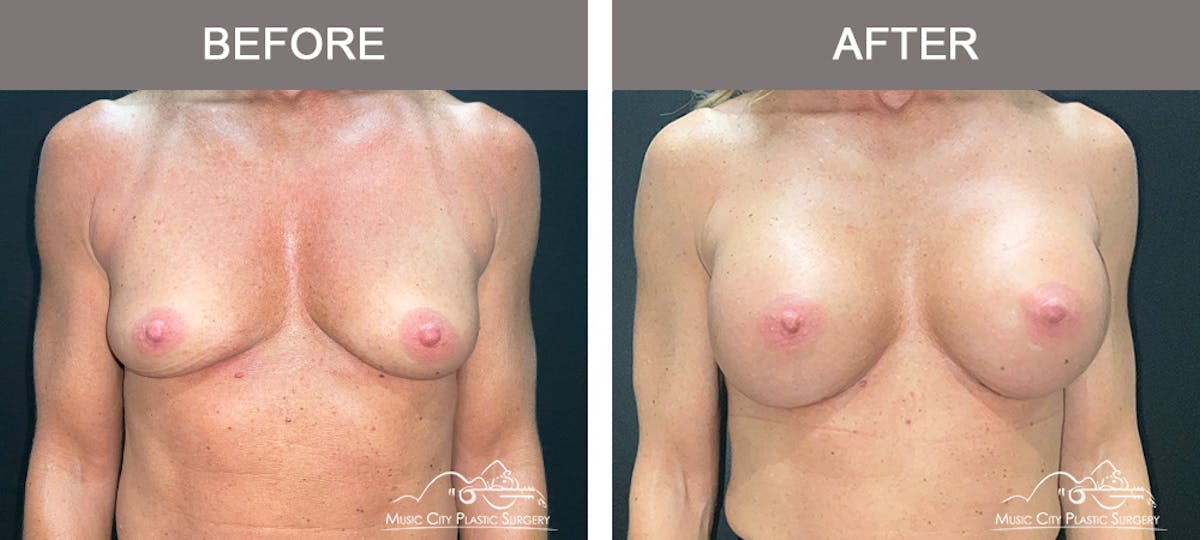 Breast Augmentation Before & After Gallery - Patient 237642 - Image 1