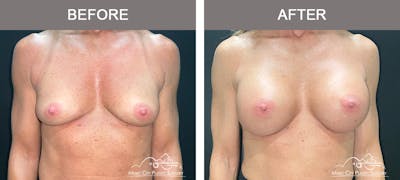 Breast Augmentation Before & After Gallery - Patient 237642 - Image 1