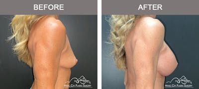 Breast Augmentation Before & After Gallery - Patient 237642 - Image 3