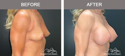 Breast Augmentation Before & After Gallery - Patient 237642 - Image 2