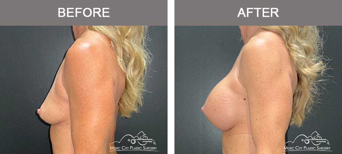 Breast Augmentation Before & After Gallery - Patient 237642 - Image 5