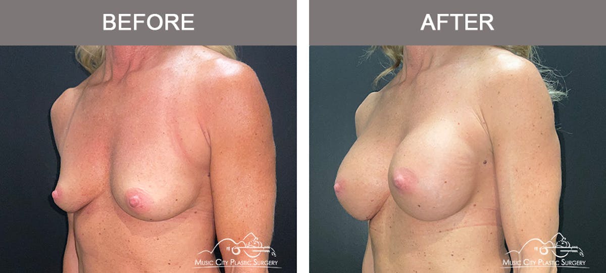 Breast Augmentation Before & After Gallery - Patient 237642 - Image 4