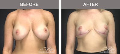 Capsulectomy Before & After Gallery - Patient 137996 - Image 1