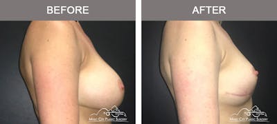 Capsulectomy Before & After Gallery - Patient 137996 - Image 3