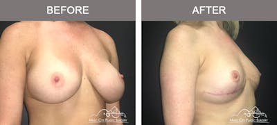 Capsulectomy Before & After Gallery - Patient 137996 - Image 2