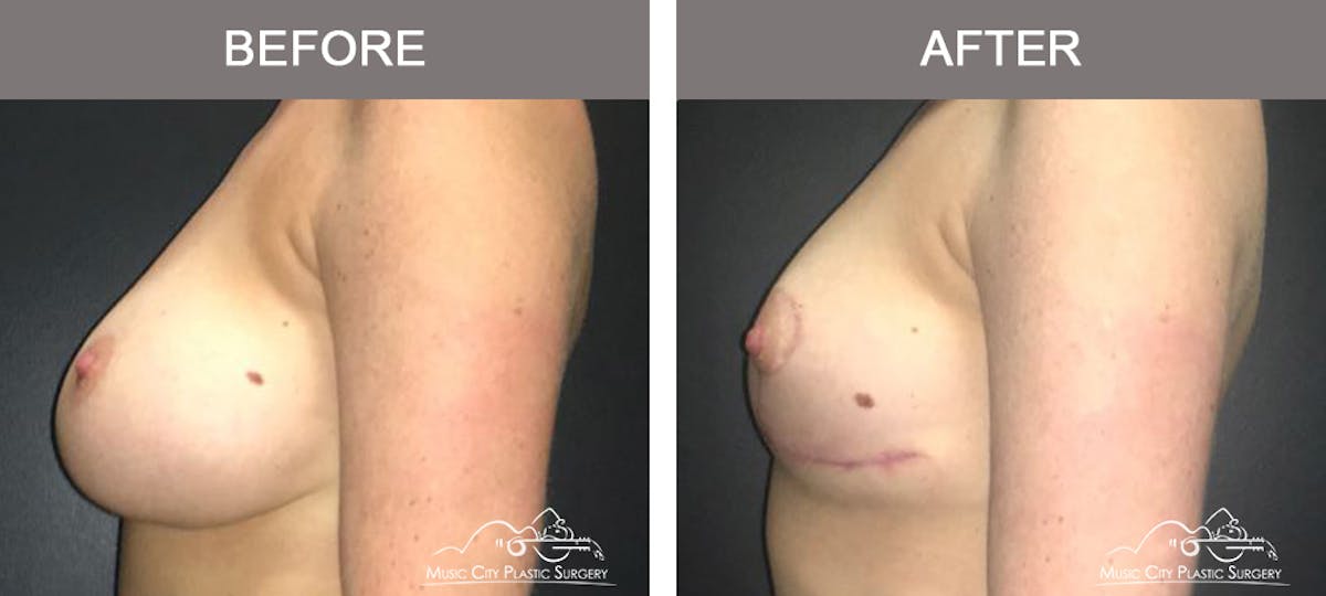 Capsulectomy Before & After Gallery - Patient 137996 - Image 5