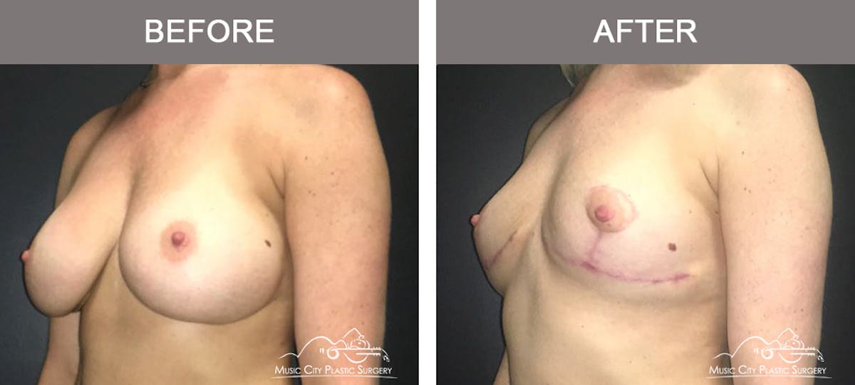 Capsulectomy Before & After Gallery - Patient 137996 - Image 4