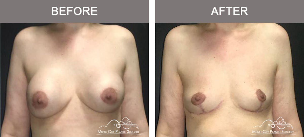 Capsulectomy Before & After Gallery - Patient 275714 - Image 1