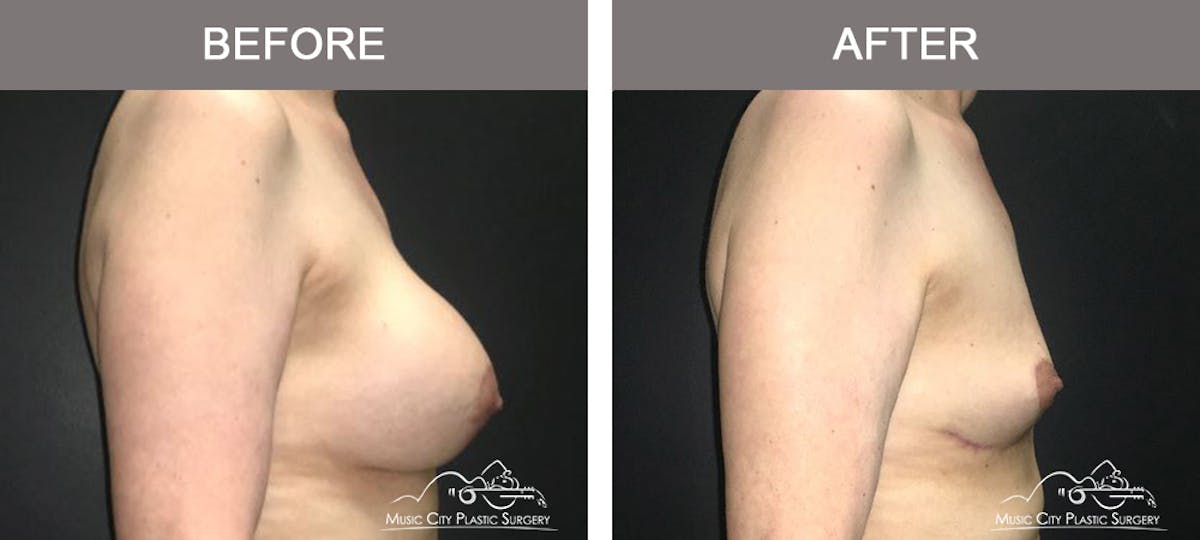 Breast Lift Before & After Gallery - Patient 320685 - Image 3
