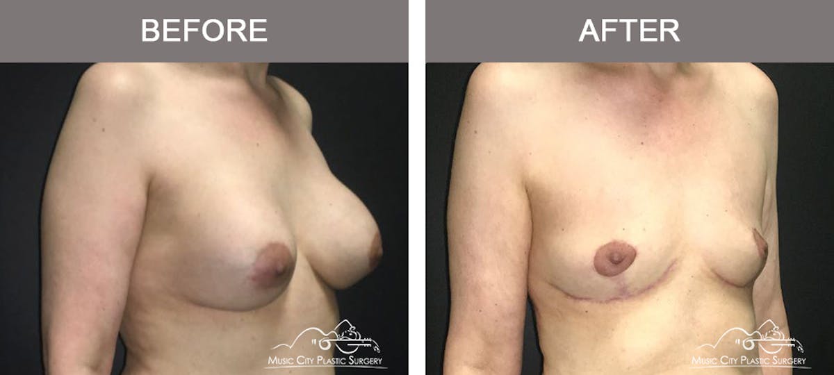 Breast Lift Before & After Gallery - Patient 320685 - Image 2