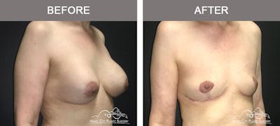 Breast Lift Before & After Gallery - Patient 320685 - Image 2
