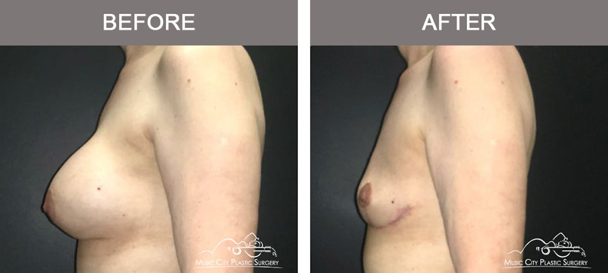 Capsulectomy Before & After Gallery - Patient 275714 - Image 5