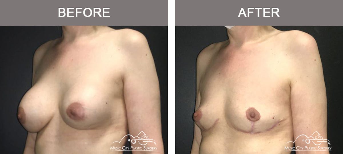 Breast Lift Before & After Gallery - Patient 320685 - Image 4