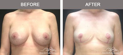 Capsulectomy Before & After Gallery - Patient 243533 - Image 1