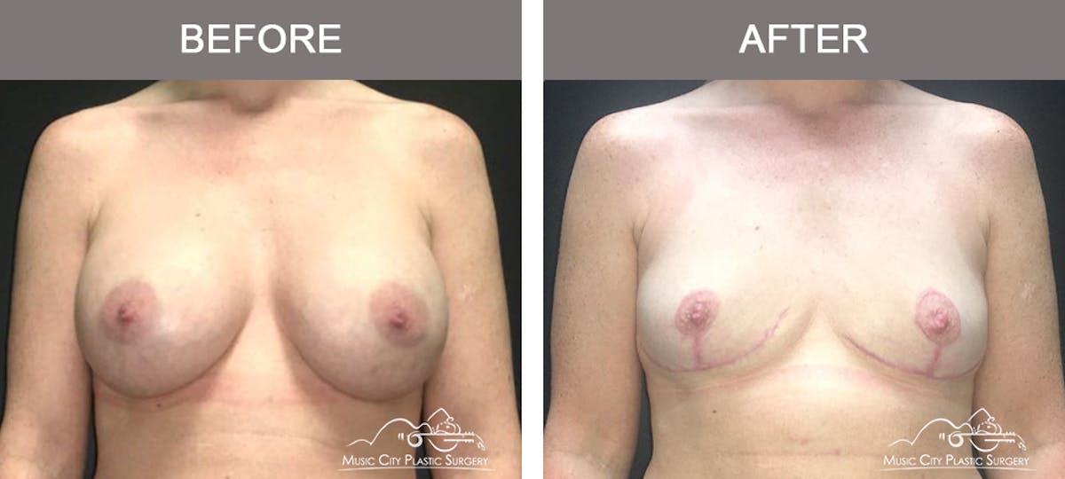 Breast Lift Before & After Gallery - Patient 387506 - Image 1