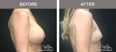 Capsulectomy Before & After Gallery - Patient 243533 - Image 3