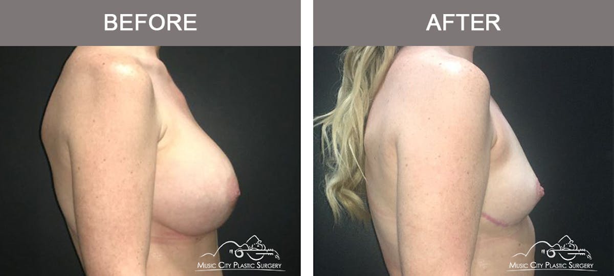 Capsulectomy Before & After Gallery - Patient 243533 - Image 3