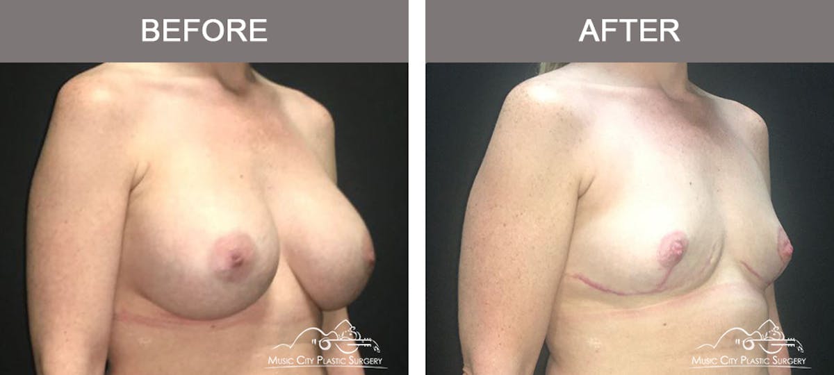 Breast Lift Before & After Gallery - Patient 387506 - Image 2