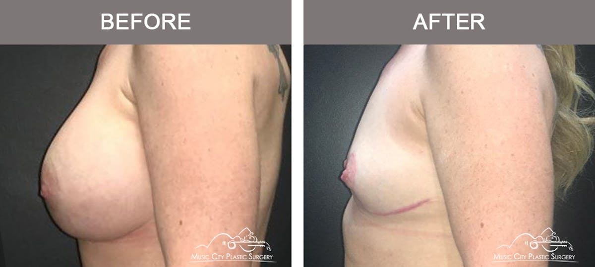Breast Lift Before & After Gallery - Patient 387506 - Image 5