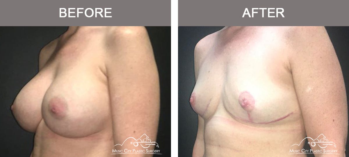 Capsulectomy Before & After Gallery - Patient 243533 - Image 4