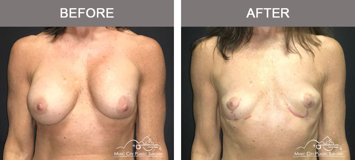 Breast Lift Before & After Gallery - Patient 314179 - Image 1