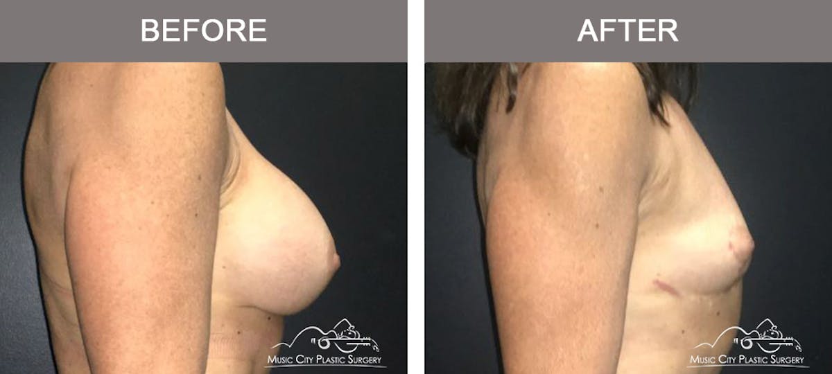 Capsulectomy Before & After Gallery - Patient 407307 - Image 3