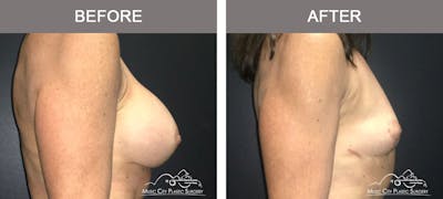 Capsulectomy Before & After Gallery - Patient 407307 - Image 3