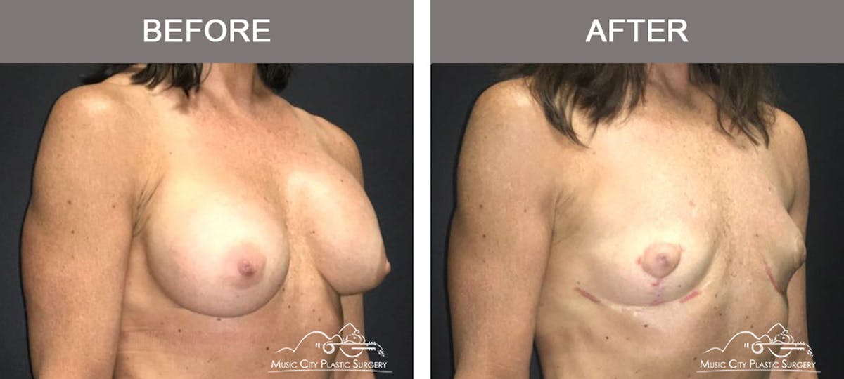 Breast Lift Before & After Gallery - Patient 314179 - Image 2