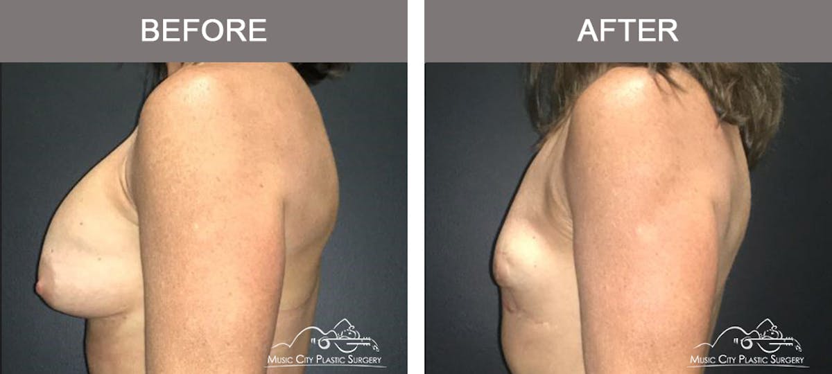 Breast Lift Before & After Gallery - Patient 314179 - Image 5