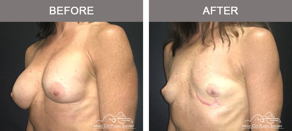 Capsulectomy Before & After Gallery - Patient 407307 - Image 4