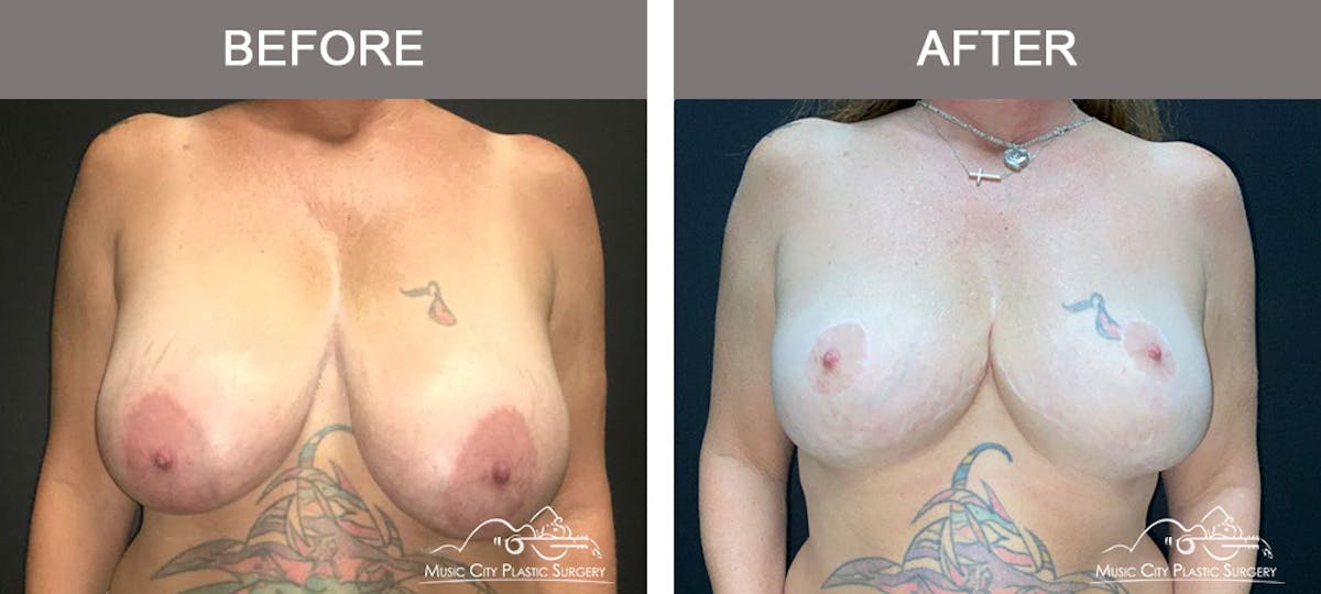 Breast Lift Before & After Gallery - Patient 321345 - Image 1