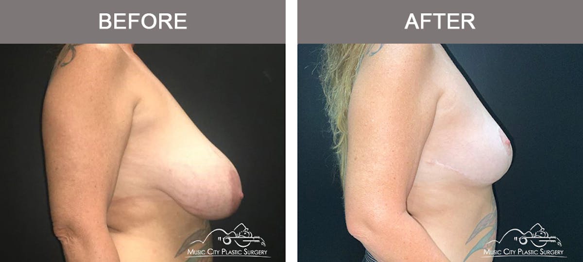 Capsulectomy Before & After Gallery - Patient 153480 - Image 3