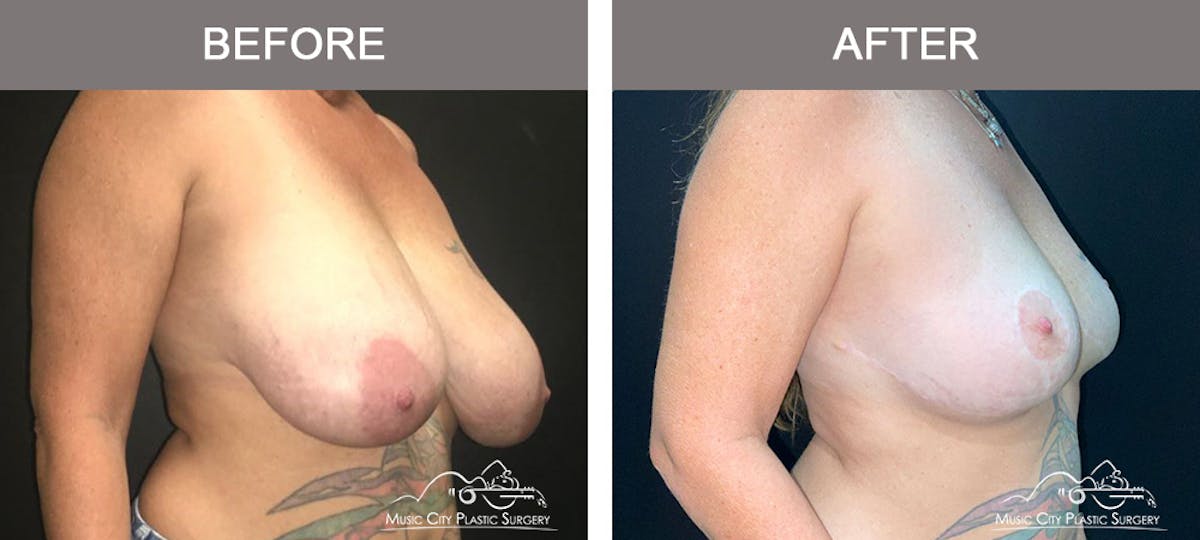 Breast Lift Before & After Gallery - Patient 321345 - Image 2