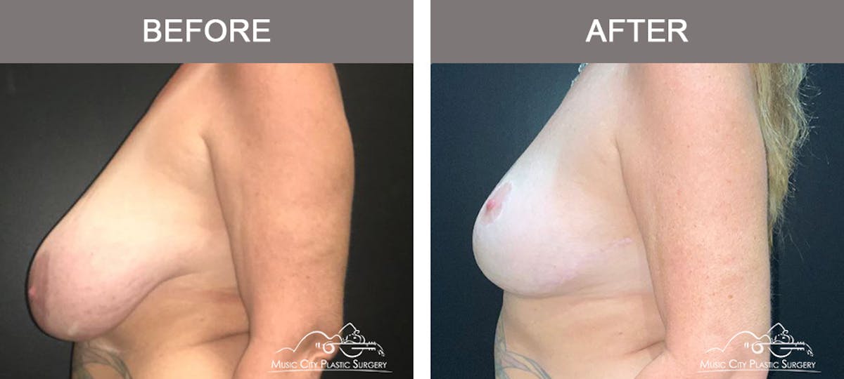 Breast Lift Before & After Gallery - Patient 321345 - Image 5