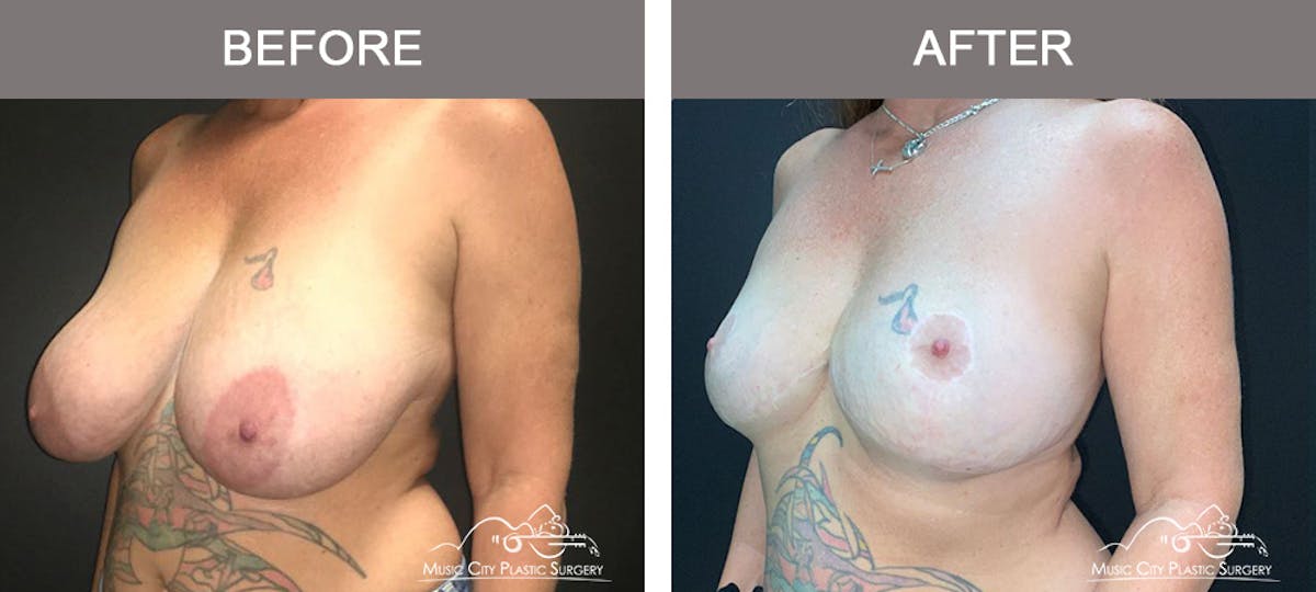 Breast Lift Before & After Gallery - Patient 321345 - Image 4