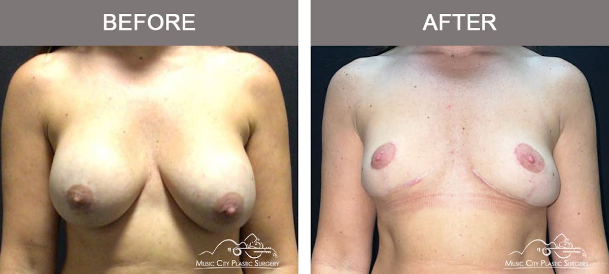 Breast Lift Before & After Gallery - Patient 163609 - Image 1