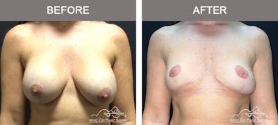 Capsulectomy Before & After Gallery - Patient 161018 - Image 1