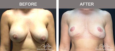 Capsulectomy Before & After Gallery - Patient 161018 - Image 1