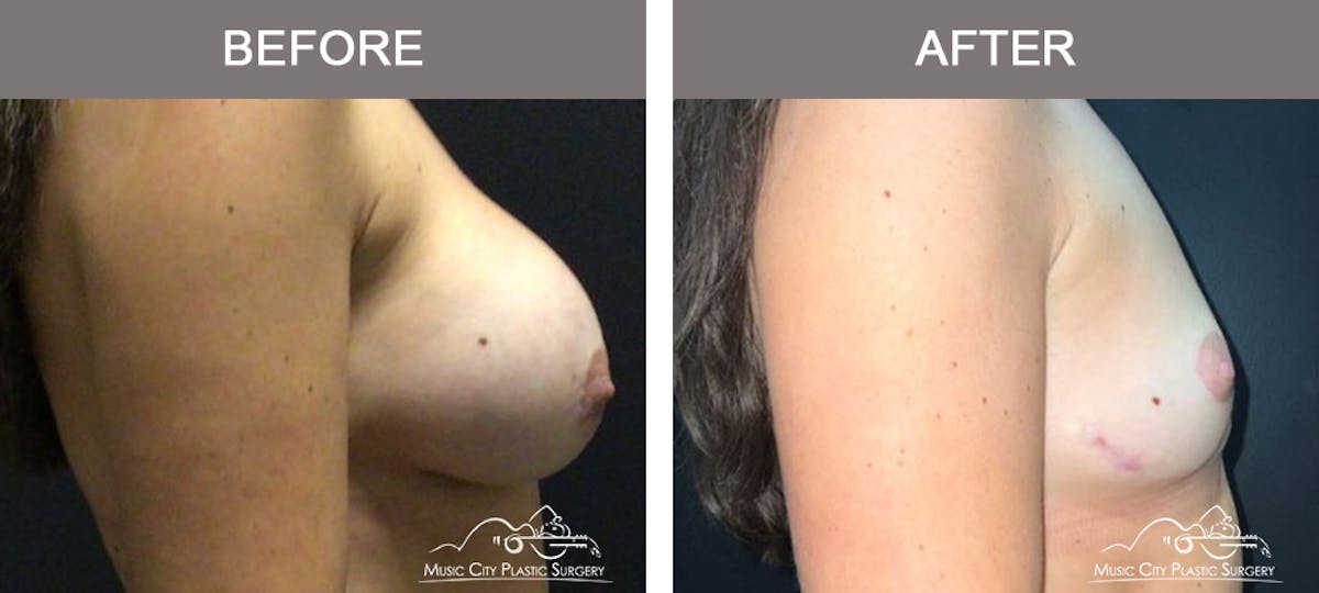 Breast Lift Before & After Gallery - Patient 163609 - Image 3