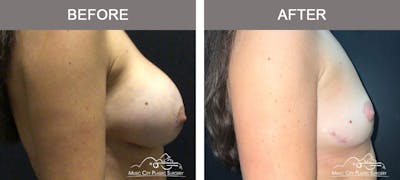 Capsulectomy Before & After Gallery - Patient 161018 - Image 3