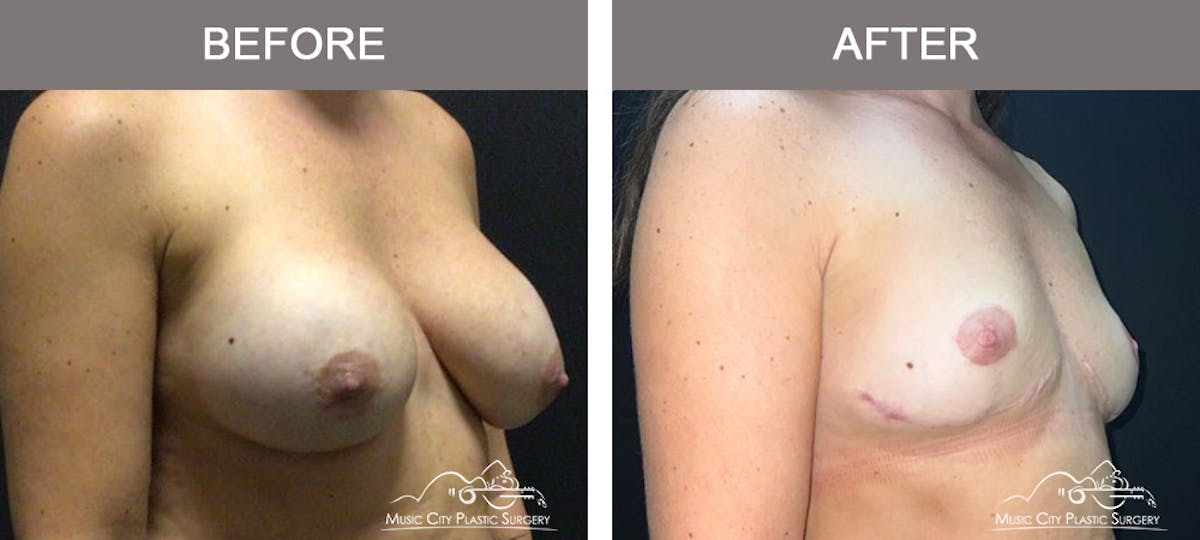 Breast Lift Before & After Gallery - Patient 163609 - Image 2