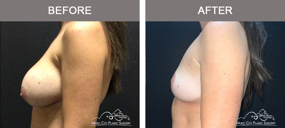 Breast Lift Before & After Gallery - Patient 163609 - Image 5